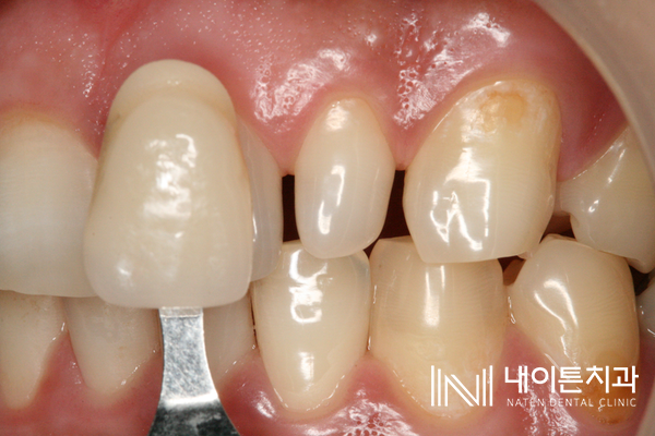 Treatment case image 10