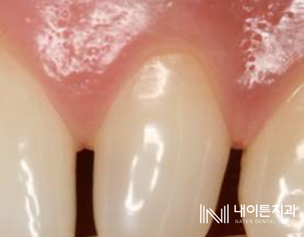 Treatment case image 20