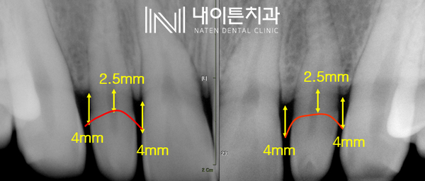Treatment case image 21