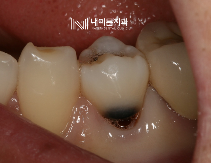 Treatment case image 1