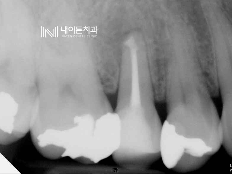 Treatment case image 6