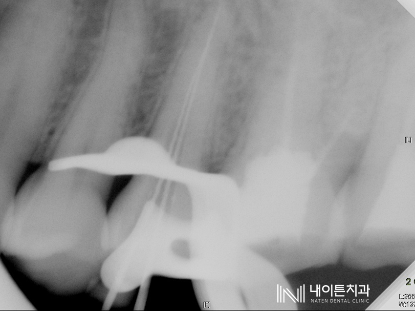 Treatment case image 4