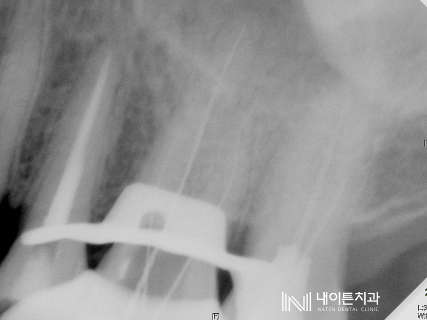 Treatment case image 5