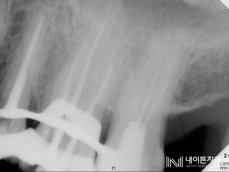 Treatment case image 8