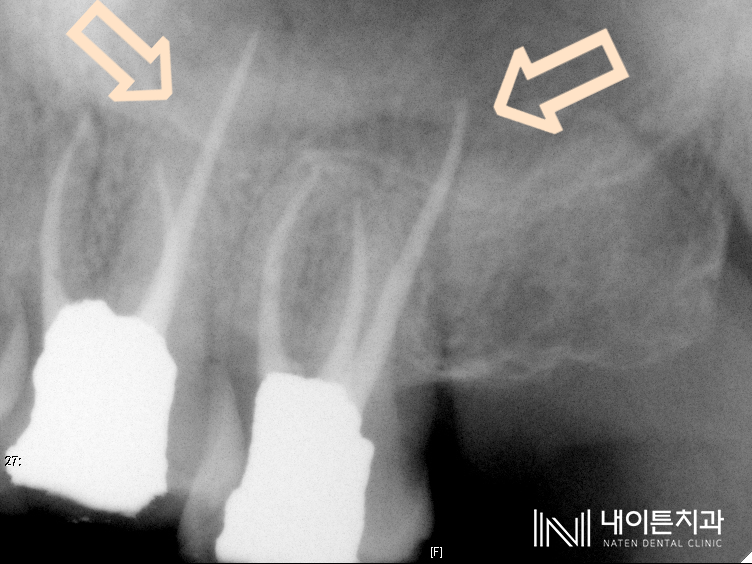 Treatment case image 11