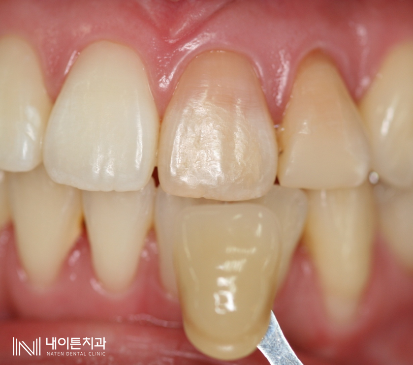 Treatment case image 4