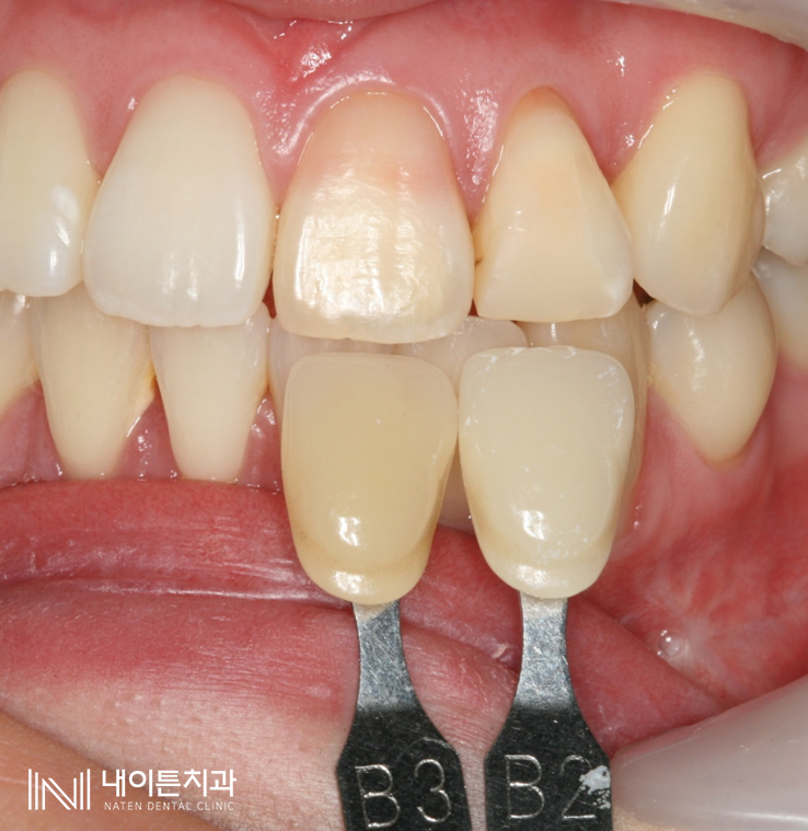 Treatment case image 5