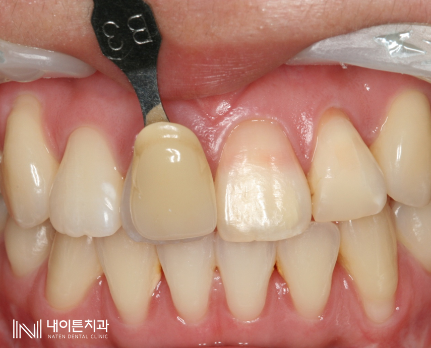 Treatment case image 6