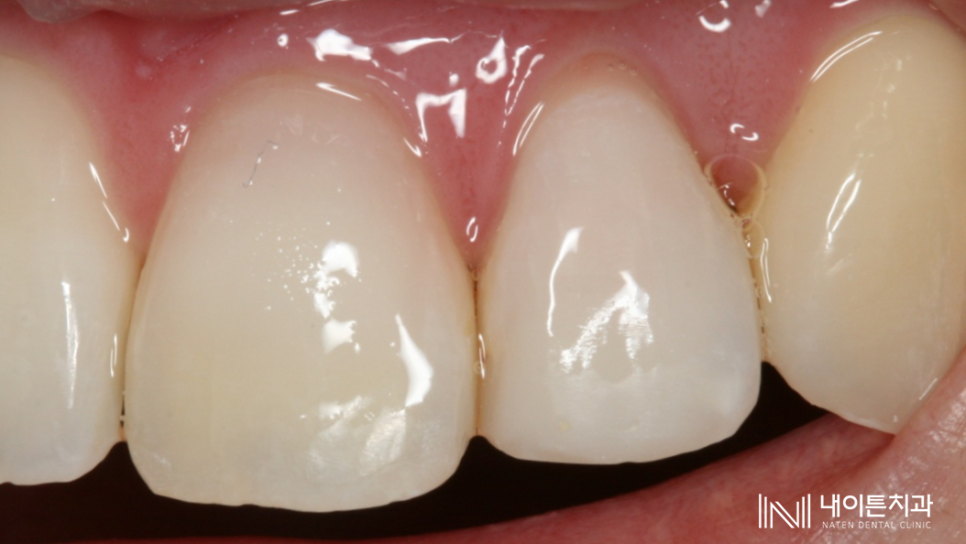 Treatment case image 14