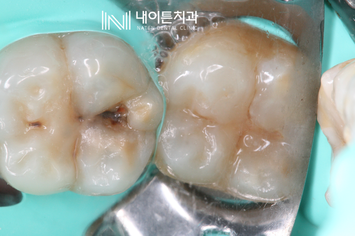 Treatment case image 2