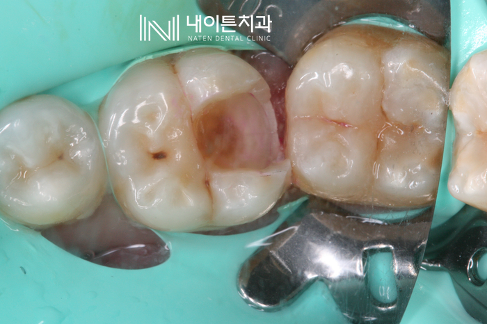 Treatment case image 3