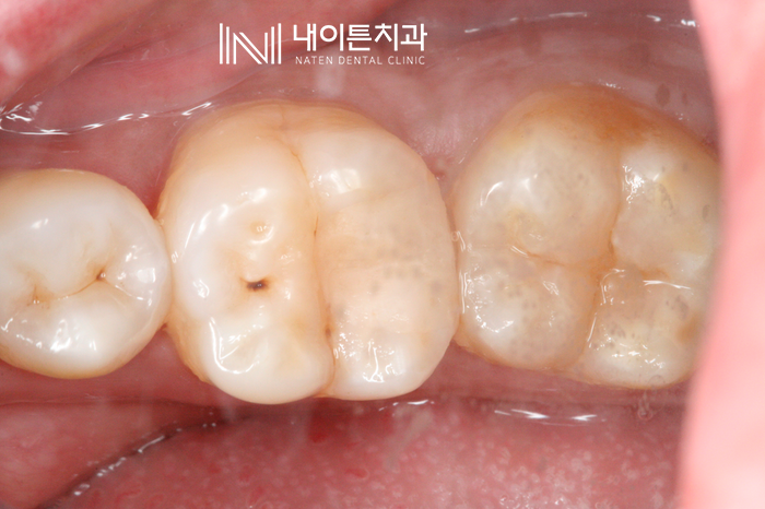 Treatment case image 4