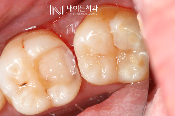 Treatment case image 5