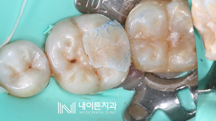 Treatment case image 13
