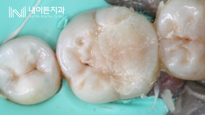 Treatment case image 14