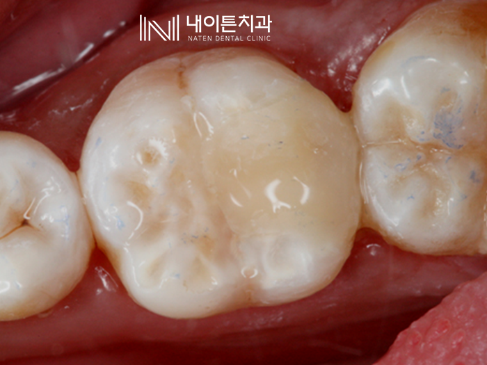 Treatment case image 15