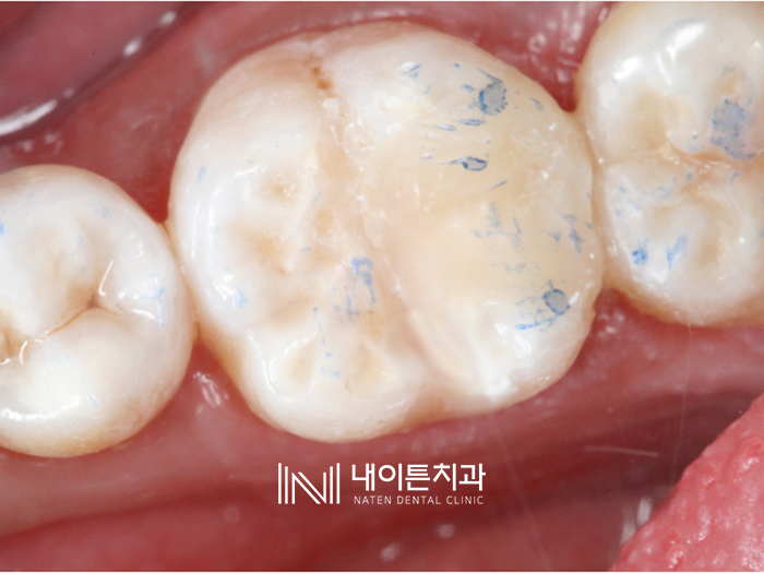 Treatment case image 16