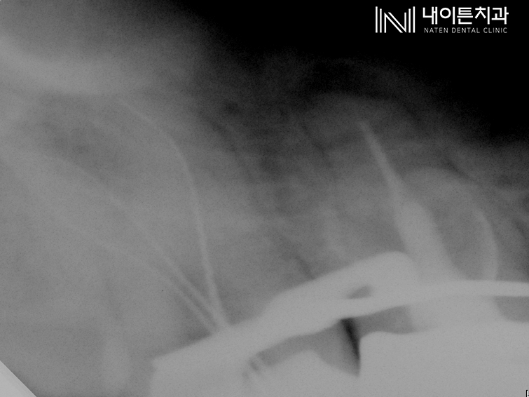 Treatment case image 2
