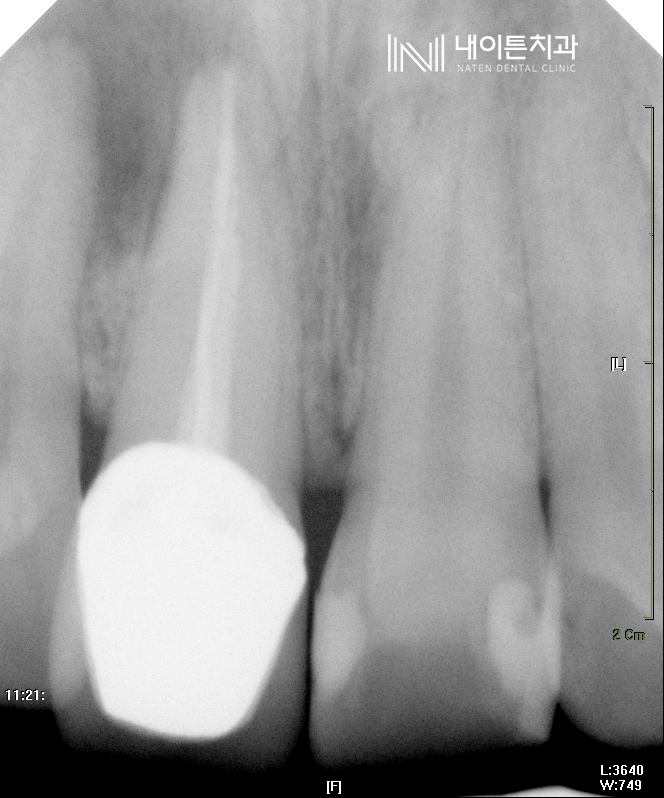 Treatment case image 2