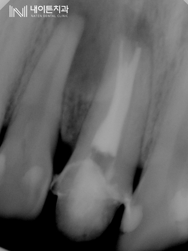 Treatment case image 5