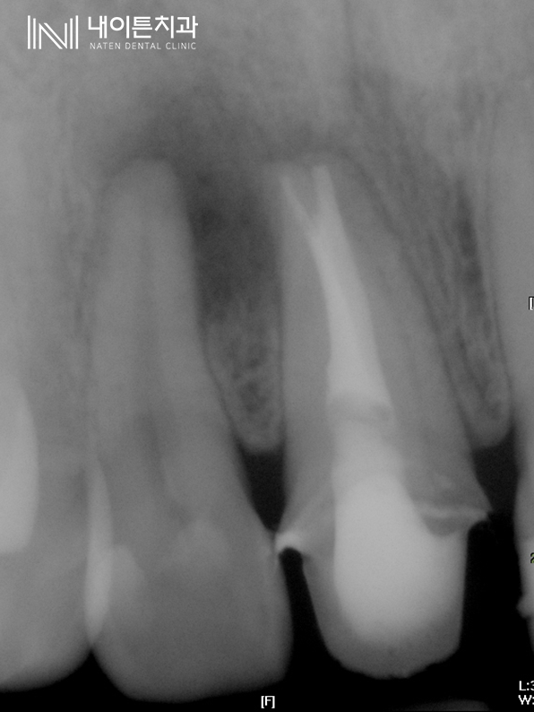 Treatment case image 6