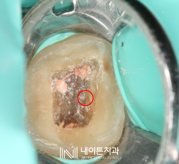 Treatment case image 4