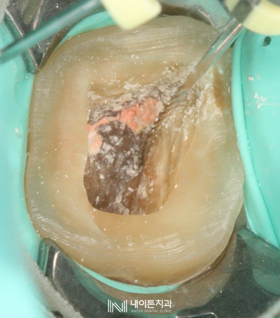 Treatment case image 5