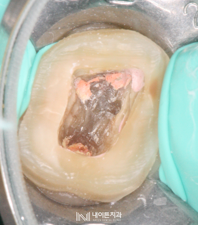 Treatment case image 6
