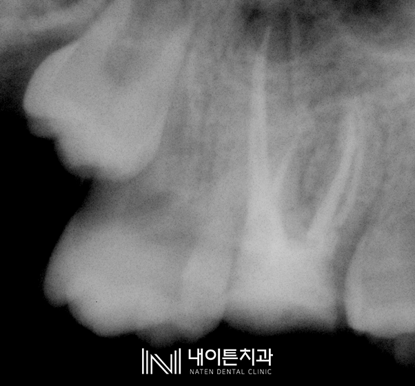 Treatment case image 11