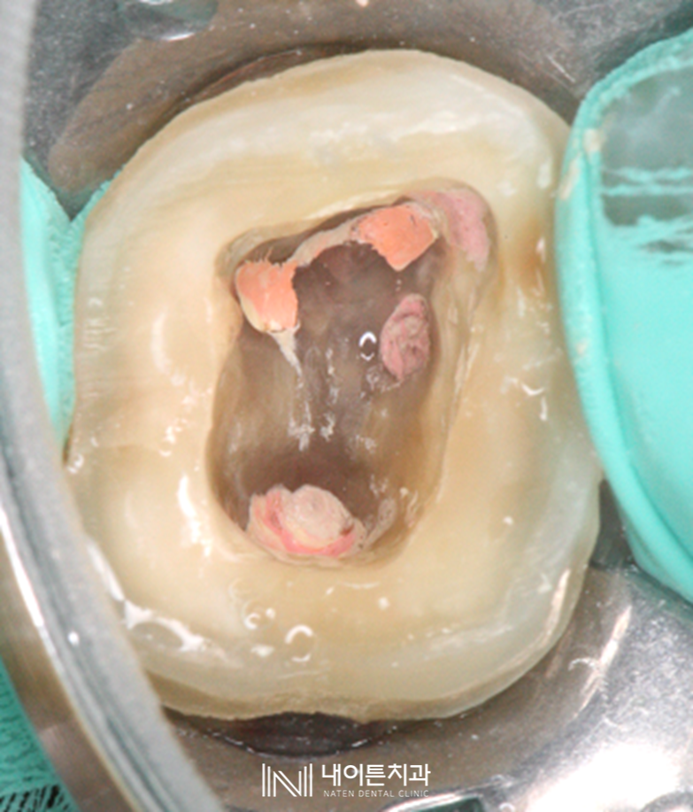Treatment case image 12