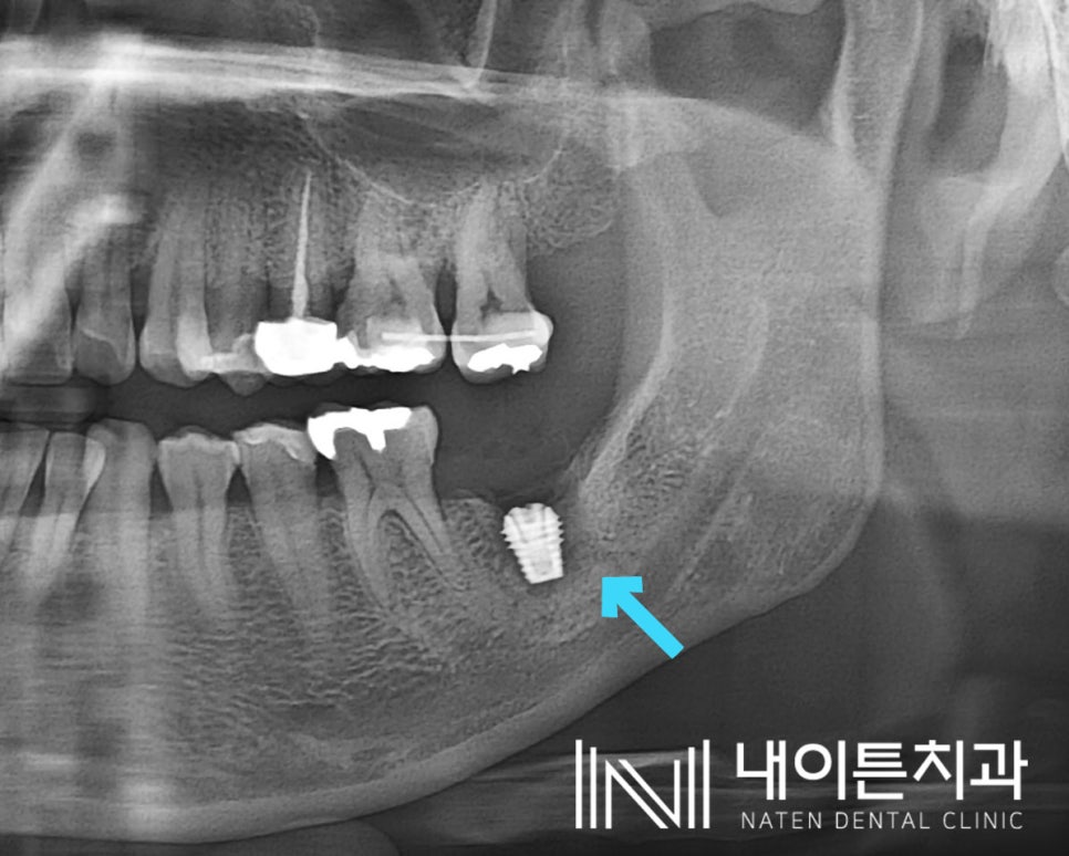 Treatment case image 2