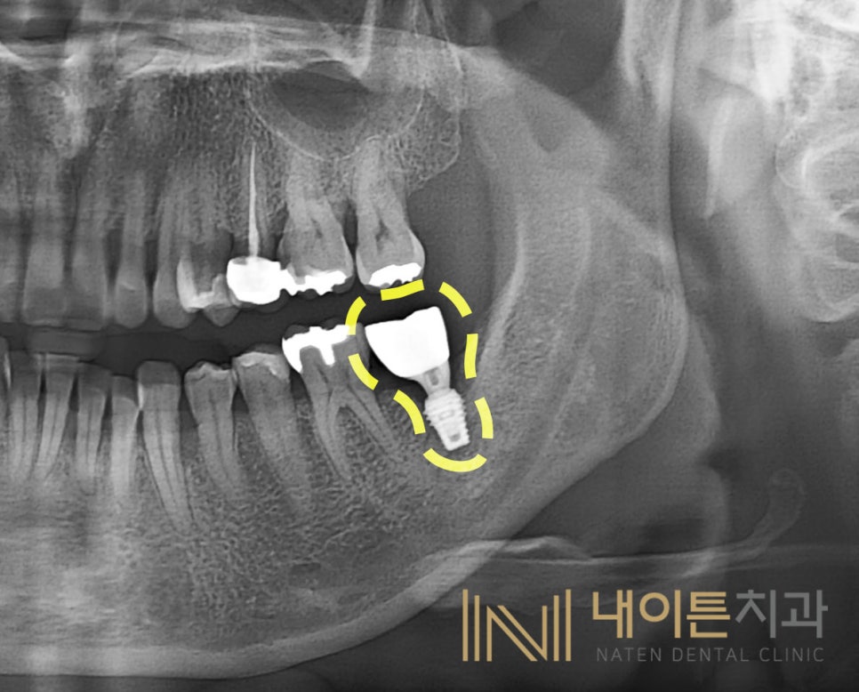 Treatment case image 3