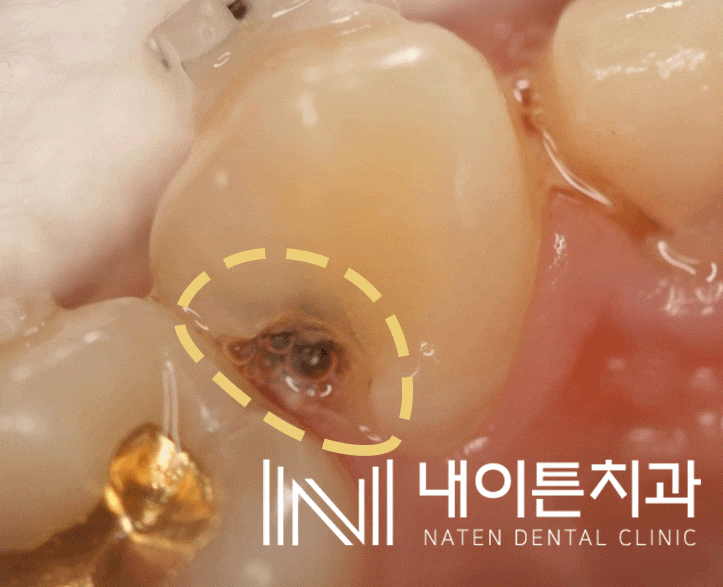 Treatment case image 2