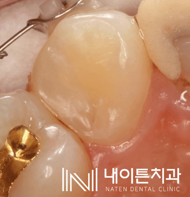 Treatment case image 7