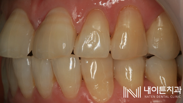 Treatment case image 4
