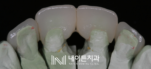 Treatment case image 14