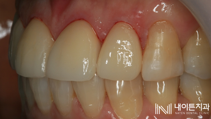 Treatment case image 23