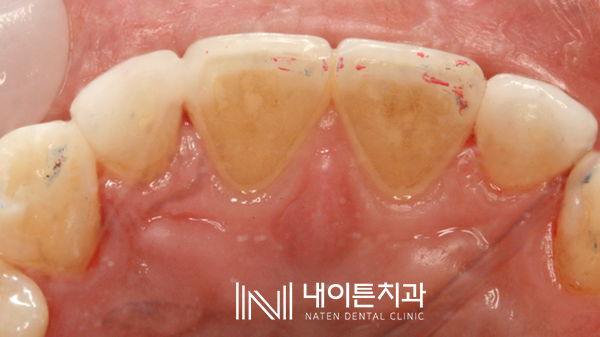 Treatment case image 24