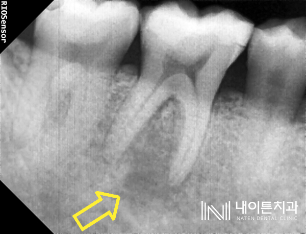 Treatment case image 3