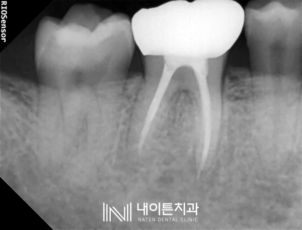 Treatment case image 6