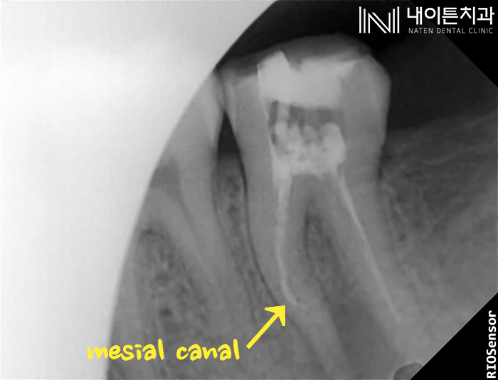 Treatment case image 2