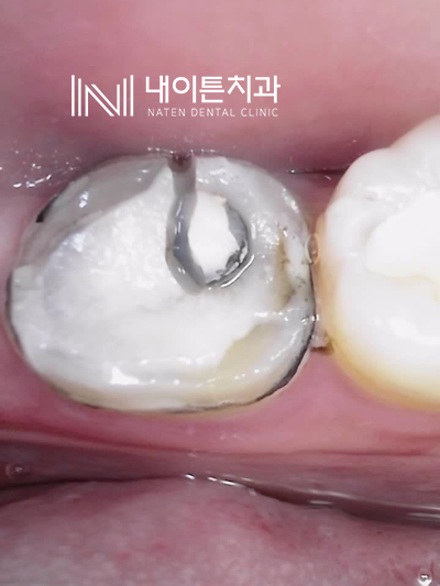 Treatment case image 3