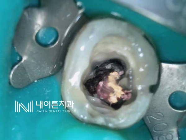 Treatment case image 4