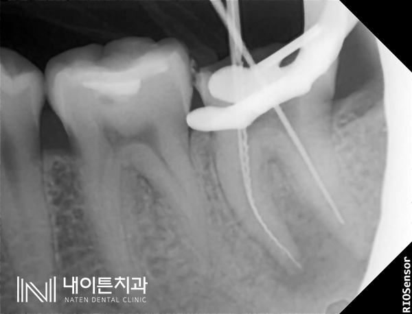 Treatment case image 5