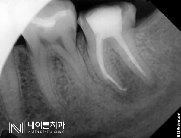 Treatment case image 6