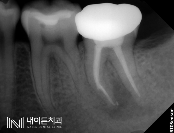 Treatment case image 11