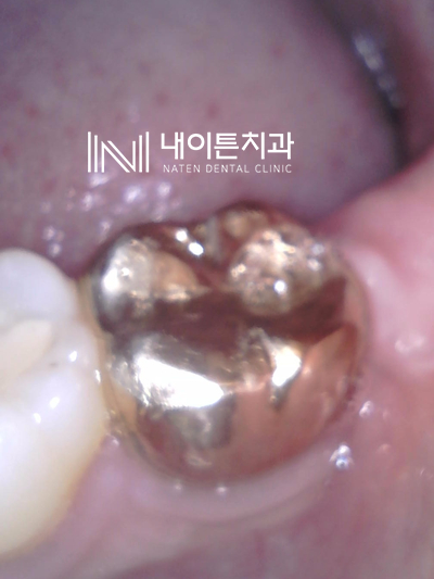 Treatment case image 12