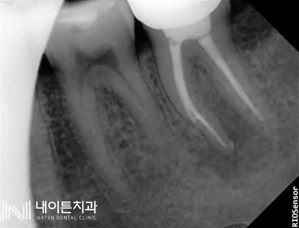 Treatment case image 13