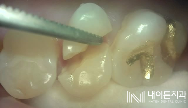 Treatment case image 2