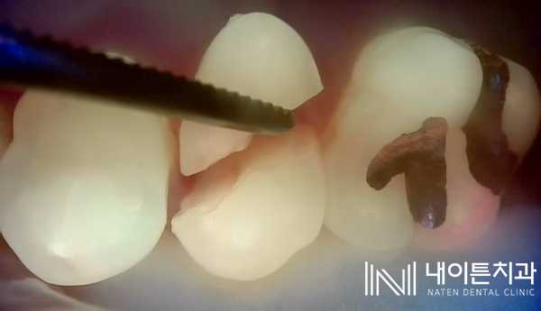 Treatment case image 3